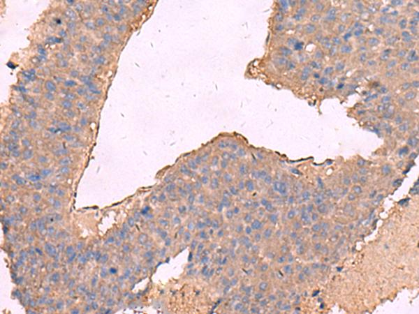 KCNN2 Antibody - Immunohistochemistry of paraffin-embedded Human liver cancer tissue  using KCNN2 Polyclonal Antibody at dilution of 1:65(×200)
