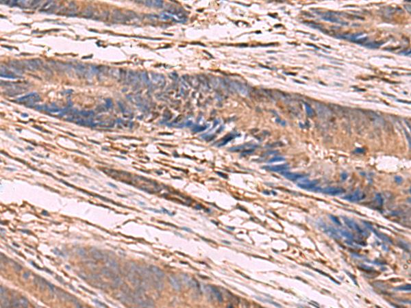 KCNN2 Antibody - Immunohistochemistry of paraffin-embedded Human colorectal cancer tissue  using KCNN2 Polyclonal Antibody at dilution of 1:65(×200)