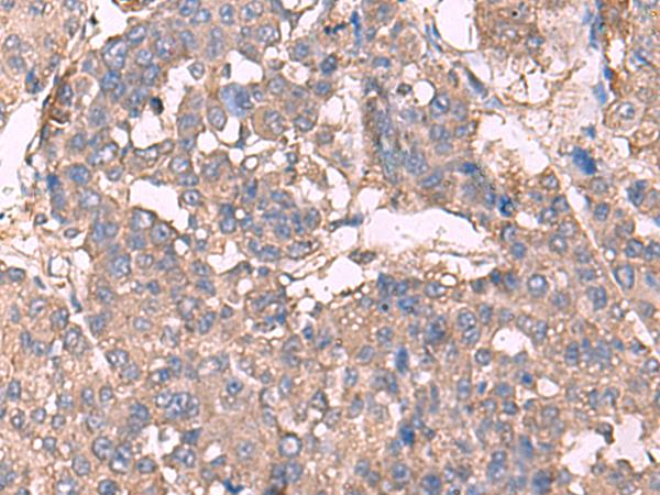 KCNN2 Antibody - Immunohistochemistry of paraffin-embedded Human liver cancer tissue  using KCNN2 Polyclonal Antibody at dilution of 1:30(×200)