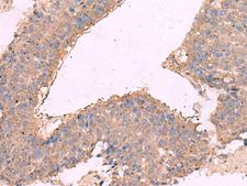 KCNN3 / SK3 Antibody - Immunohistochemistry of paraffin-embedded Human liver cancer tissue  using KCNN3 Polyclonal Antibody at dilution of 1:40(×200)