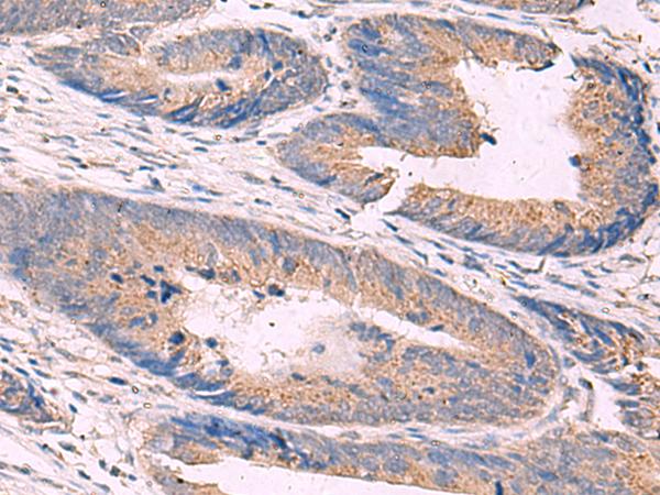 KCNN3 / SK3 Antibody - Immunohistochemistry of paraffin-embedded Human colorectal cancer tissue  using KCNN3 Polyclonal Antibody at dilution of 1:40(×200)