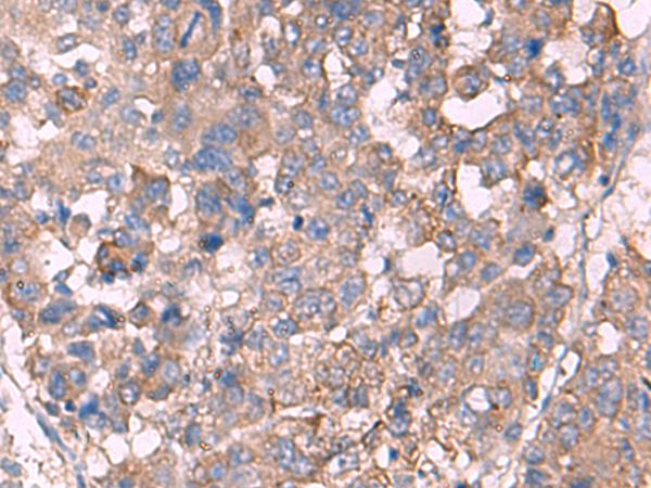 KCNN3 / SK3 Antibody - Immunohistochemistry of paraffin-embedded Human liver cancer tissue  using KCNN3 Polyclonal Antibody at dilution of 1:60(×200)