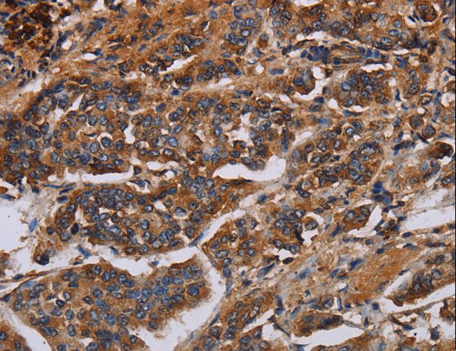 KCNQ1 / KVLQT1 Antibody - Immunohistochemistry of paraffin-embedded Human breast cancer using KCNQ1 Polyclonal Antibody at dilution of 1:50.