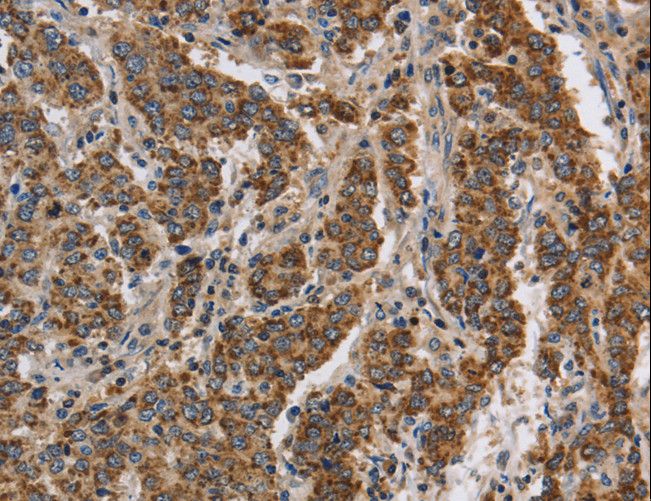 KCNQ4 Antibody - Immunohistochemistry of paraffin-embedded Human liver cancer using KCNQ4 Polyclonal Antibody at dilution of 1:40.