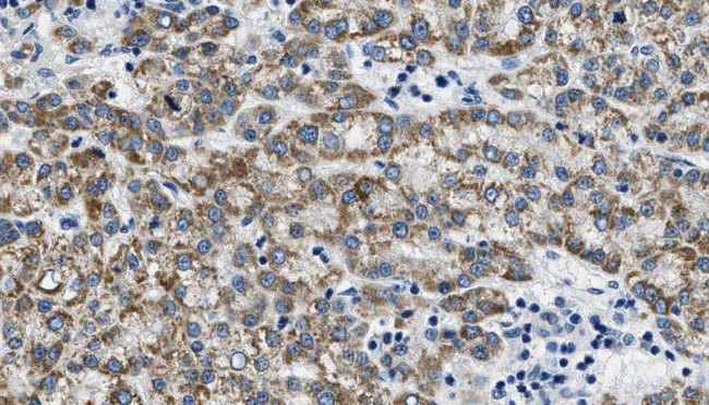 KCNQ4 Antibody - 1:100 staining human liver carcinoma tissues by IHC-P. The sample was formaldehyde fixed and a heat mediated antigen retrieval step in citrate buffer was performed. The sample was then blocked and incubated with the antibody for 1.5 hours at 22°C. An HRP conjugated goat anti-rabbit antibody was used as the secondary.