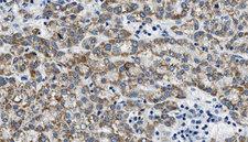 KCNQ4 Antibody - 1:100 staining human liver carcinoma tissues by IHC-P. The sample was formaldehyde fixed and a heat mediated antigen retrieval step in citrate buffer was performed. The sample was then blocked and incubated with the antibody for 1.5 hours at 22°C. An HRP conjugated goat anti-rabbit antibody was used as the secondary.