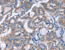 KCNQ5 Antibody - Immunohistochemistry of paraffin-embedded Human thyroid cancer using KCNQ5 Polyclonal Antibody at dilution of 1:30.