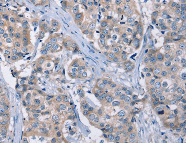 KCNQ5 Antibody - Immunohistochemistry of paraffin-embedded Human breast cancer using KCNQ5 Polyclonal Antibody at dilution of 1:30.