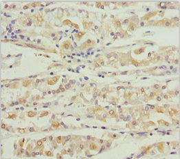 KCNS3 Antibody - Immunohistochemistry of paraffin-embedded human gastric cancer at dilution 1:100
