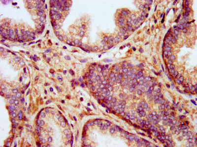 KCNT1 / KCa4.1 Antibody - Immunohistochemistry image at a dilution of 1:400 and staining in paraffin-embedded human prostate cancer performed on a Leica BondTM system. After dewaxing and hydration, antigen retrieval was mediated by high pressure in a citrate buffer (pH 6.0) . Section was blocked with 10% normal goat serum 30min at RT. Then primary antibody (1% BSA) was incubated at 4 °C overnight. The primary is detected by a biotinylated secondary antibody and visualized using an HRP conjugated SP system.