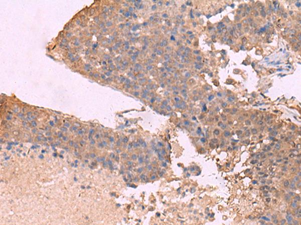 KCNU1 / KCNMC1 Antibody - Immunohistochemistry of paraffin-embedded Human liver cancer tissue  using KCNU1 Polyclonal Antibody at dilution of 1:45(×200)