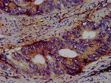 KCNV2 / Kv11.1 Antibody - Immunohistochemistry image at a dilution of 1:500 and staining in paraffin-embedded human colon cancer performed on a Leica BondTM system. After dewaxing and hydration, antigen retrieval was mediated by high pressure in a citrate buffer (pH 6.0) . Section was blocked with 10% normal goat serum 30min at RT. Then primary antibody (1% BSA) was incubated at 4 °C overnight. The primary is detected by a biotinylated secondary antibody and visualized using an HRP conjugated SP system.