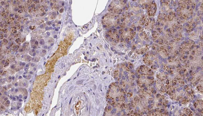KCTD12 Antibody - 1:100 staining human pancreas carcinoma tissue by IHC-P. The sample was formaldehyde fixed and a heat mediated antigen retrieval step in citrate buffer was performed. The sample was then blocked and incubated with the antibody for 1.5 hours at 22°C. An HRP conjugated goat anti-rabbit antibody was used as the secondary.