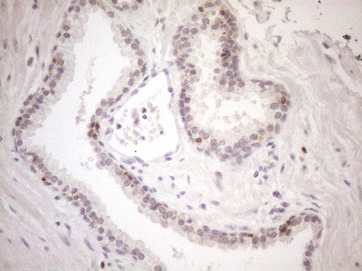 KCTD13 Antibody - Immunohistochemical staining of paraffin-embedded Carcinoma of Human prostate tissue using anti-KCTD13 mouse monoclonal antibody. (Heat-induced epitope retrieval by 1mM EDTA in 10mM Tris buffer. (pH8.5) at 120°C for 3 min. (1:150)