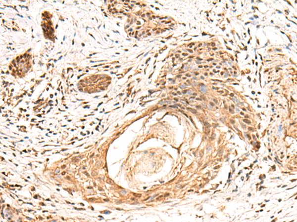 KCTD13 Antibody - Immunohistochemistry of paraffin-embedded Human esophagus cancer tissue  using KCTD13 Polyclonal Antibody at dilution of 1:55(×200)