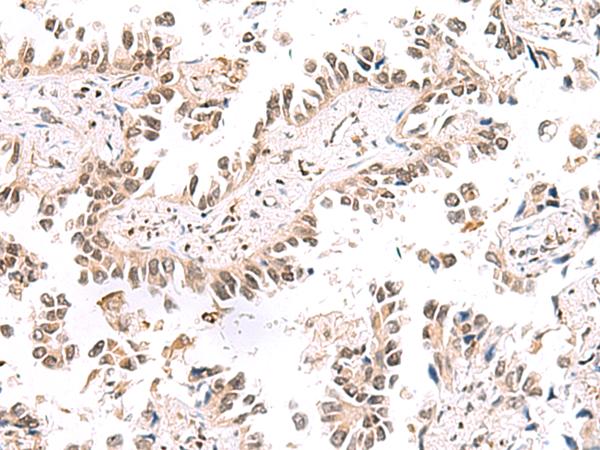 KCTD13 Antibody - Immunohistochemistry of paraffin-embedded Human lung cancer tissue  using KCTD13 Polyclonal Antibody at dilution of 1:50(×200)