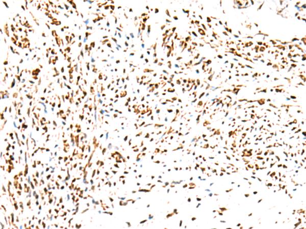KCTD13 Antibody - Immunohistochemistry of paraffin-embedded Human cervical cancer tissue  using KCTD13 Polyclonal Antibody at dilution of 1:50(×200)