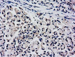 KCTD14 Antibody - IHC of paraffin-embedded Adenocarcinoma of Human colon tissue using anti-KCTD14 mouse monoclonal antibody. (Heat-induced epitope retrieval by 10mM citric buffer, pH6.0, 100C for 10min).