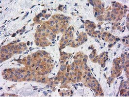 KCTD14 Antibody - IHC of paraffin-embedded Adenocarcinoma of Human breast tissue using anti-KCTD14 mouse monoclonal antibody. (Heat-induced epitope retrieval by 10mM citric buffer, pH6.0, 100C for 10min).