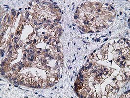 KCTD14 Antibody - IHC of paraffin-embedded Adenocarcinoma of Human ovary tissue using anti-KCTD14 mouse monoclonal antibody. (Heat-induced epitope retrieval by 10mM citric buffer, pH6.0, 100C for 10min).