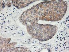 KCTD14 Antibody - IHC of paraffin-embedded Adenocarcinoma of Human breast tissue using anti-KCTD14 mouse monoclonal antibody.