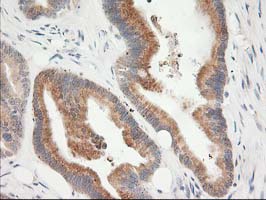 KCTD14 Antibody - IHC of paraffin-embedded Adenocarcinoma of Human colon tissue using anti-KCTD14 mouse monoclonal antibody.