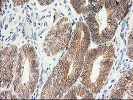 KCTD14 Antibody - IHC of paraffin-embedded Adenocarcinoma of Human endometrium tissue using anti-KCTD14 mouse monoclonal antibody.