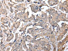 KCTD16 Antibody - Immunohistochemistry of paraffin-embedded Human breast cancer tissue  using KCTD16 Polyclonal Antibody at dilution of 1:25(×200)