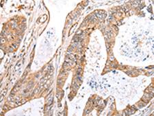 KCTD16 Antibody - Immunohistochemistry of paraffin-embedded Human colorectal cancer tissue  using KCTD16 Polyclonal Antibody at dilution of 1:30(×200)