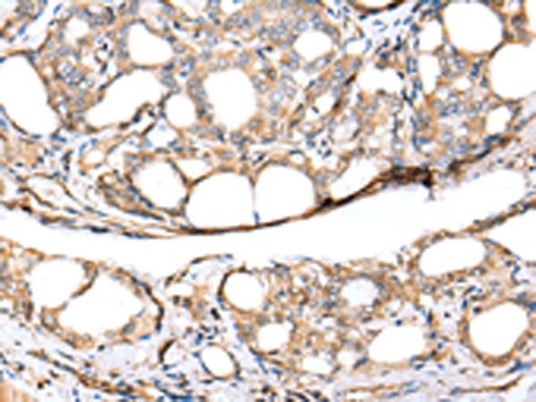 KCTD16 Antibody - Immunohistochemistry of paraffin-embedded Human thyroid cancer tissue  using KCTD16 Polyclonal Antibody at dilution of 1:30(×200)