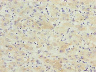 KCTD19 Antibody - Immunohistochemistry of paraffin-embedded human liver cancer using KCTD19 Antibody at dilution of 1:100