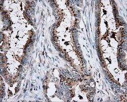KCTD5 Antibody - Immunohistochemical staining of paraffin-embedded Adenocarcinoma of colon tissue using anti- mouse monoclonal antibody. (Dilution 1:50).