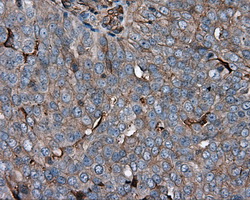 KCTD5 Antibody - Immunohistochemical staining of paraffin-embedded Adenocarcinoma of ovary tissue using anti- mouse monoclonal antibody. (Dilution 1:50).