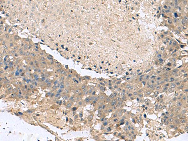 KCTD7 Antibody - Immunohistochemistry of paraffin-embedded Human liver cancer tissue  using KCTD7 Polyclonal Antibody at dilution of 1:55(×200)