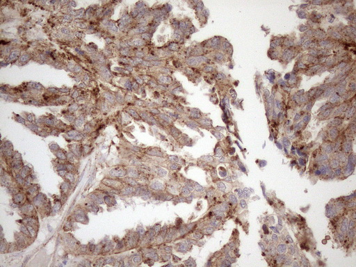 KCTD9 Antibody - Immunohistochemical staining of paraffin-embedded Adenocarcinoma of Human ovary tissue using anti-KCTD9 mouse monoclonal antibody. (Heat-induced epitope retrieval by 1mM EDTA in 10mM Tris buffer. (pH8.5) at 120°C for 3 min. (1:150)