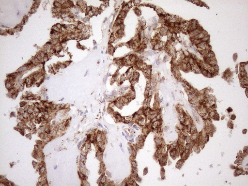 KCTD9 Antibody - Immunohistochemical staining of paraffin-embedded Carcinoma of Human thyroid tissue using anti-KCTD9 mouse monoclonal antibody. (Heat-induced epitope retrieval by 1mM EDTA in 10mM Tris buffer. (pH8.5) at 120°C for 3 min. (1:150)