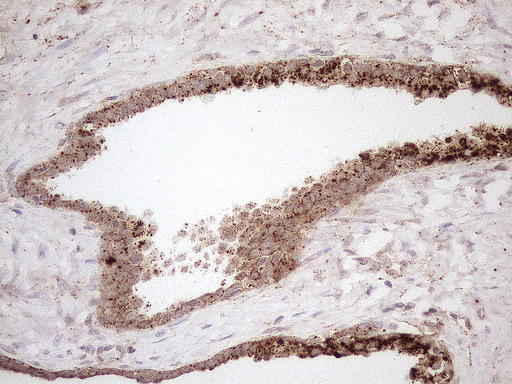KCTD9 Antibody - Immunohistochemical staining of paraffin-embedded Carcinoma of Human prostate tissue using anti-KCTD9 mouse monoclonal antibody. (Heat-induced epitope retrieval by 1mM EDTA in 10mM Tris buffer. (pH8.5) at 120°C for 3 min. (1:150)