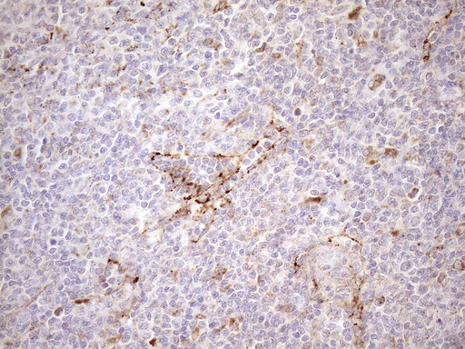 KCTD9 Antibody - Immunohistochemical staining of paraffin-embedded Human lymphoma tissue using anti-KCTD9 mouse monoclonal antibody. (Heat-induced epitope retrieval by 1mM EDTA in 10mM Tris buffer. (pH8.5) at 120°C for 3 min. (1:150)