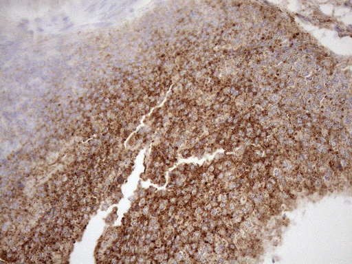 KCTD9 Antibody - Immunohistochemical staining of paraffin-embedded Adenocarcinoma of Human colon tissue using anti-KCTD9 mouse monoclonal antibody. (Heat-induced epitope retrieval by 1mM EDTA in 10mM Tris buffer. (pH8.5) at 120°C for 3 min. (1:150)