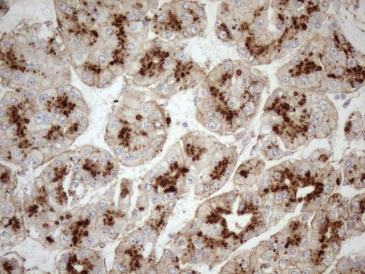 KCTD9 Antibody - Immunohistochemical staining of paraffin-embedded Carcinoma of Human liver tissue using anti-KCTD9 mouse monoclonal antibody. (Heat-induced epitope retrieval by 1mM EDTA in 10mM Tris buffer. (pH8.5) at 120°C for 3 min. (1:150)