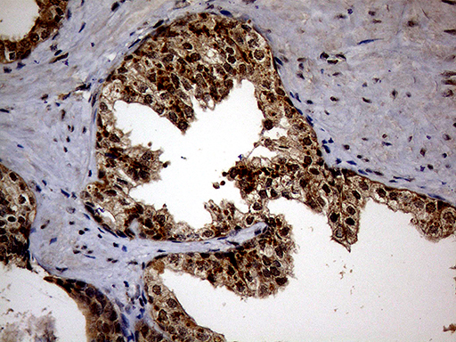 KCTD9 Antibody - Immunohistochemical staining of paraffin-embedded Carcinoma of Human prostate tissue using anti-KCTD9 mouse monoclonal antibody. (Heat-induced epitope retrieval by 1mM EDTA in 10mM Tris buffer. (pH8.5) at 120°C for 3 min. (1:150)