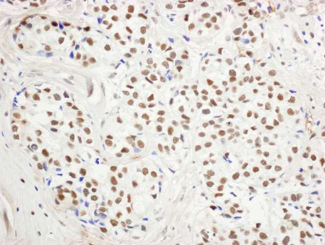 KDM1A / LSD1 Antibody - Detection of human BHC110/LSD1 by immunohistochemistry. Sample: FFPE section of human breast carcinoma. Antibody: Affinity purified rabbit anti-BHC110/LSD1 used at a dilution of 1:1,000 (1µg/ml). Detection: DAB