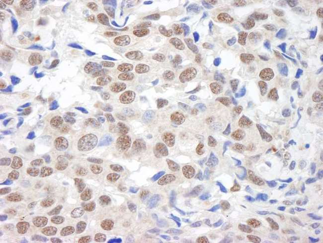 KDM1A / LSD1 Antibody - Detection of Human BHC110/LSD1 by Immunohistochemistry. Sample: FFPE section of human breast carcinoma. Antibody: Affinity purified rabbit anti-BHC110/LSD1 used at a dilution of 1:1000 (1 ug/ml).