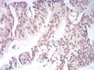 KDM1B Antibody - Immunohistochemical analysis of paraffin-embedded rectum cancer tissues using AOF1 mouse mAb with DAB staining.