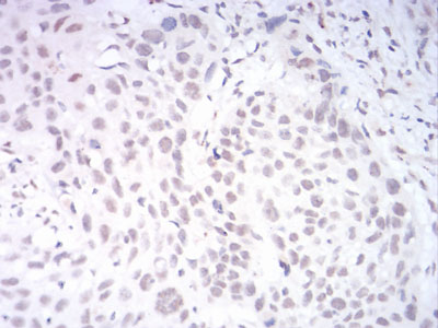 KDM1B Antibody - Immunohistochemical analysis of paraffin-embedded esophageal cancer tissues using AOF1 mouse mAb with DAB staining.