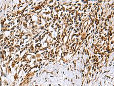 KDM2B / FBXL10 Antibody - Immunohistochemistry of paraffin-embedded Human esophagus cancer tissue  using KDM2B Polyclonal Antibody at dilution of 1:40(×200)