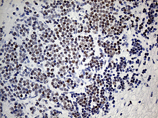 KDM3A / JMJD1A Antibody - Immunohistochemical staining of paraffin-embedded Human lymphoma tissue using anti-KDM3A mouse monoclonal antibody. (Heat-induced epitope retrieval by 1mM EDTA in 10mM Tris buffer. (pH8.5) at 120°C for 3 min. (1:150)