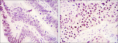 KDM3A / JMJD1A Antibody - IHC of paraffin-embedded colonic cancer tissues (left) and lung cancer tissues (right) using KDM3A mouse monoclonal antibody with DAB staining.