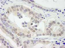 KDM3B / JMJD1B Antibody - Detection of Human JMJD1B by Immunohistochemistry. Sample: FFPE section of human prostate adenocarcinoma. Antibody: Affinity purified rabbit anti-JMJD1B used at a dilution of 1:250.