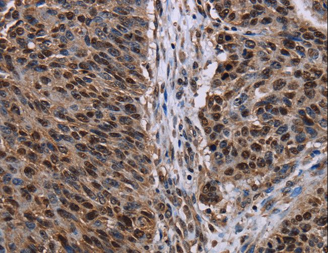 KDM3B / JMJD1B Antibody - Immunohistochemistry of paraffin-embedded Human prostate cancer using KDM3B Polyclonal Antibody at dilution of 1:50.